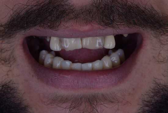 Antes e Depois Dentista Fabio Persegani Cirurgia Guiada Implante Antes