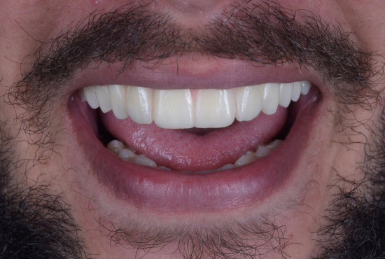 Antes e Depois Dentista Fabio Persegani Cirurgia Guiada Implante Depois