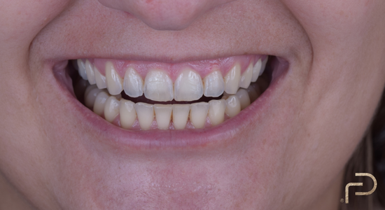 Antes e Depois Dentista Fabio Persegani Alinhadores Invisiveis Depois