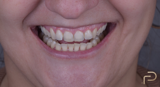 Antes e Depois Dentista Fabio Persegani Alinhadores Invisiveis Antes